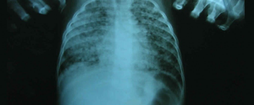 Cómo sanar al natural si hay tuberculosis