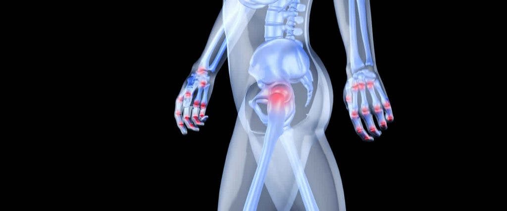 Músculos fuertes, la clave para la prevención de la osteoporosis